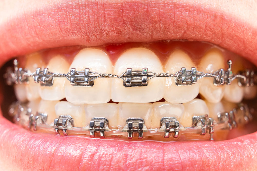 Different types of braces