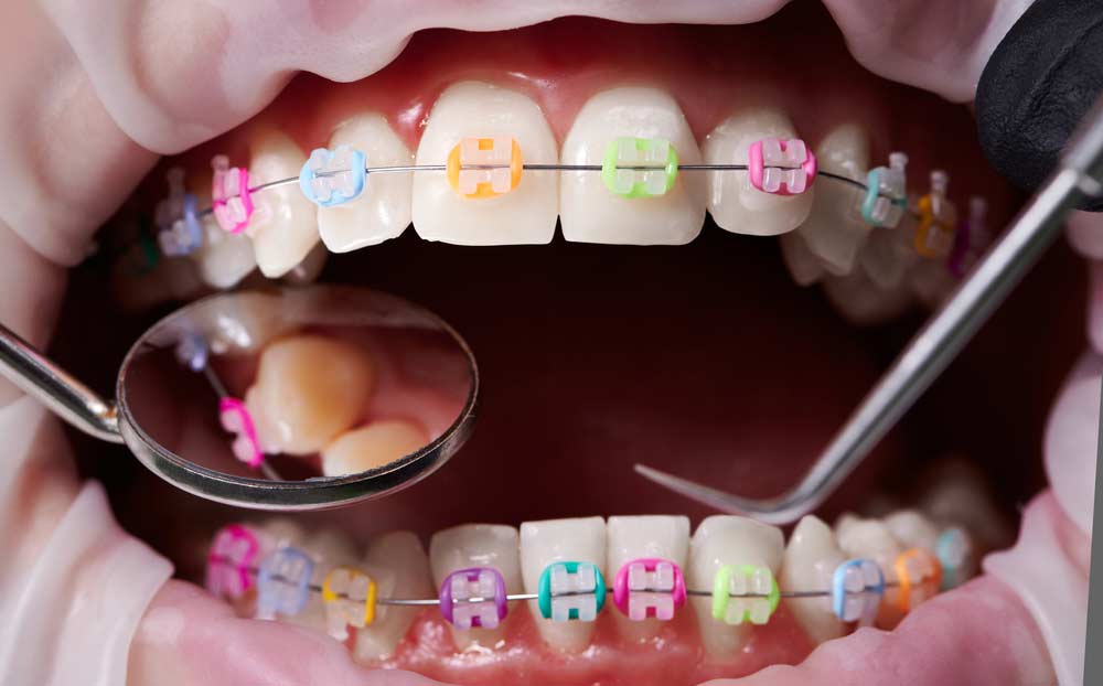 DIY Braces