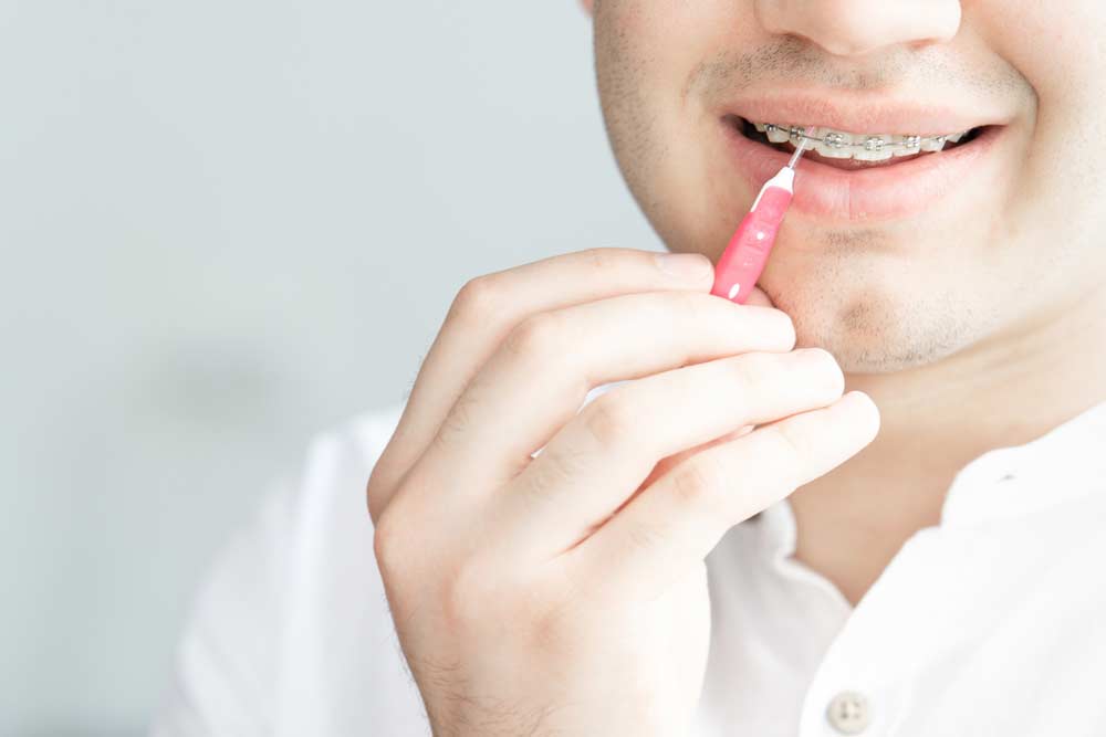 At-Home Aligners