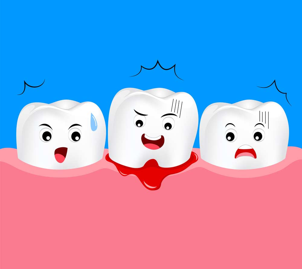 Gum Bleeding