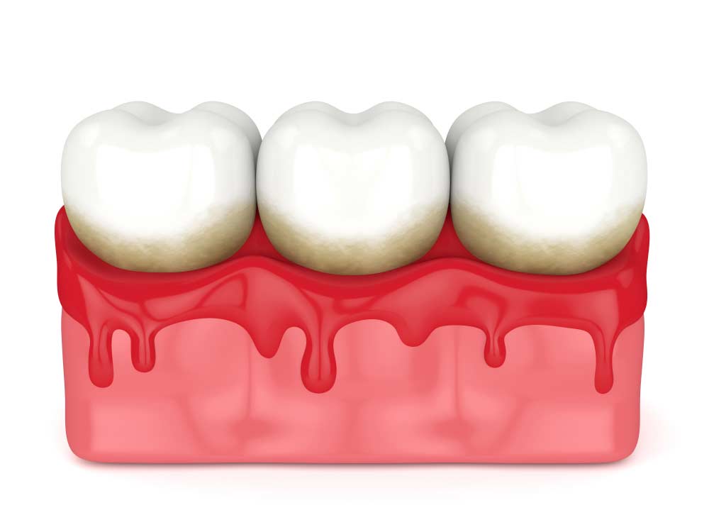 Tartar Buildup