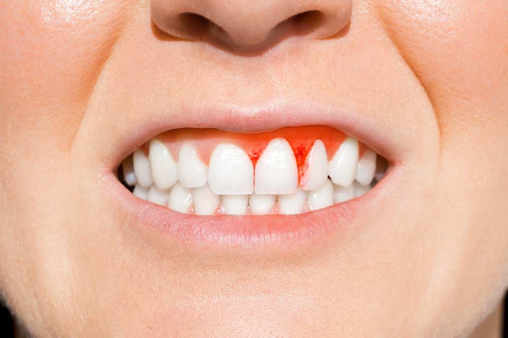 Periodontitis