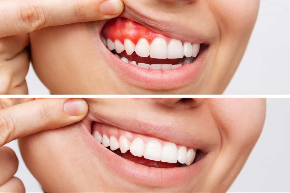 Pregnancy Gums