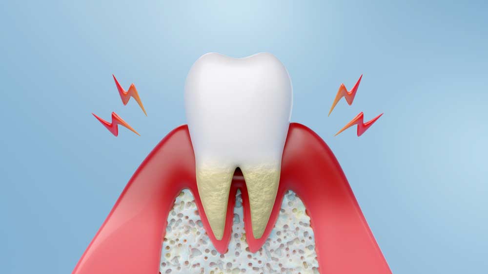 Periodontitis