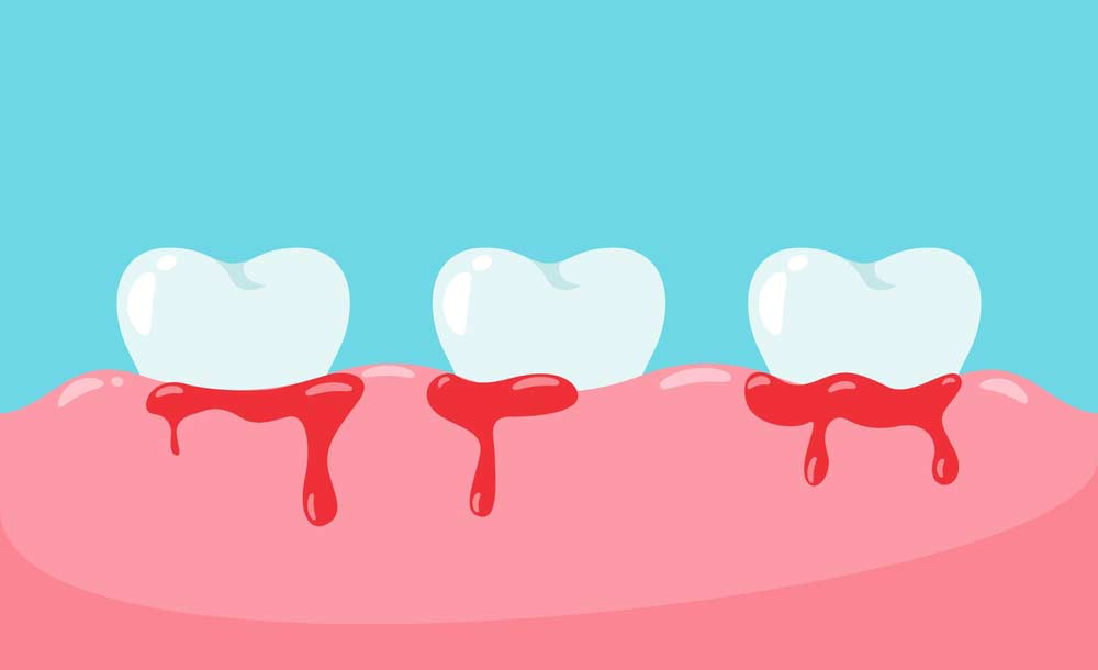 Pregnancy Gums