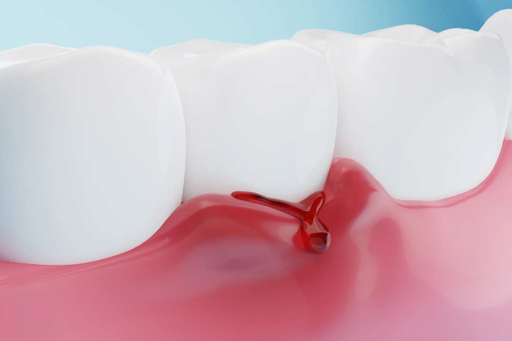 Periodontitis
