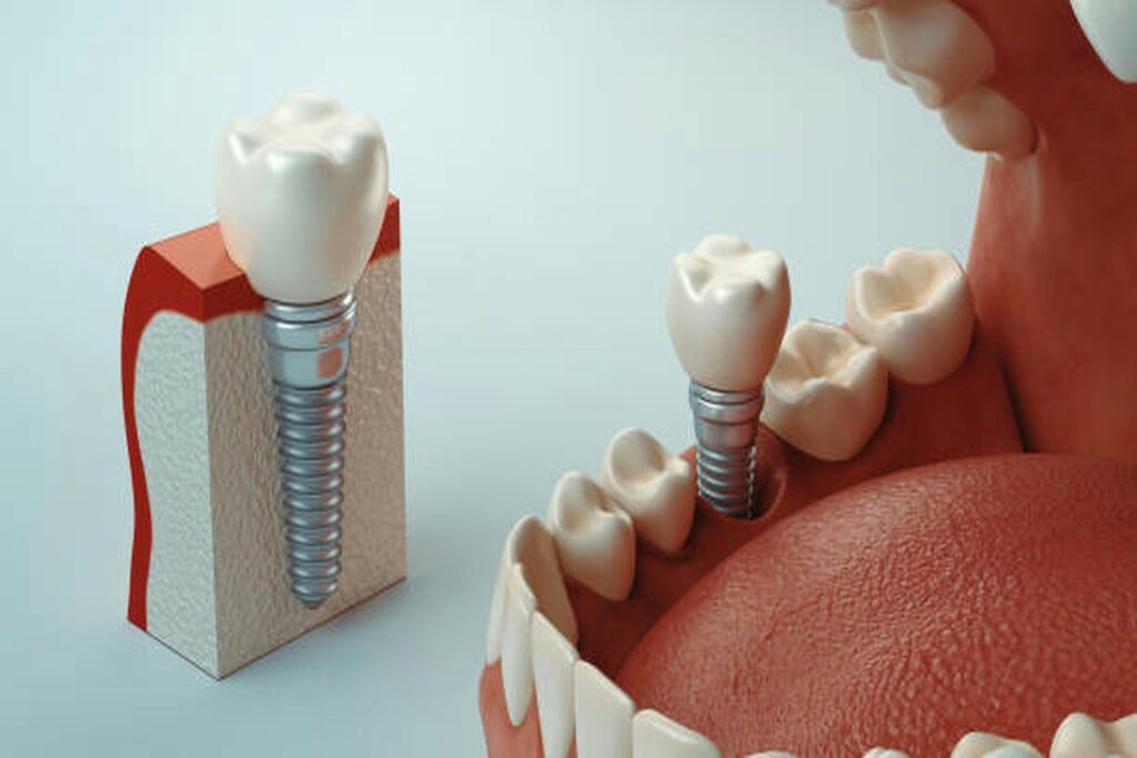 Dental implant cost