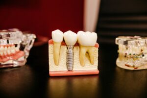 Dental implants
