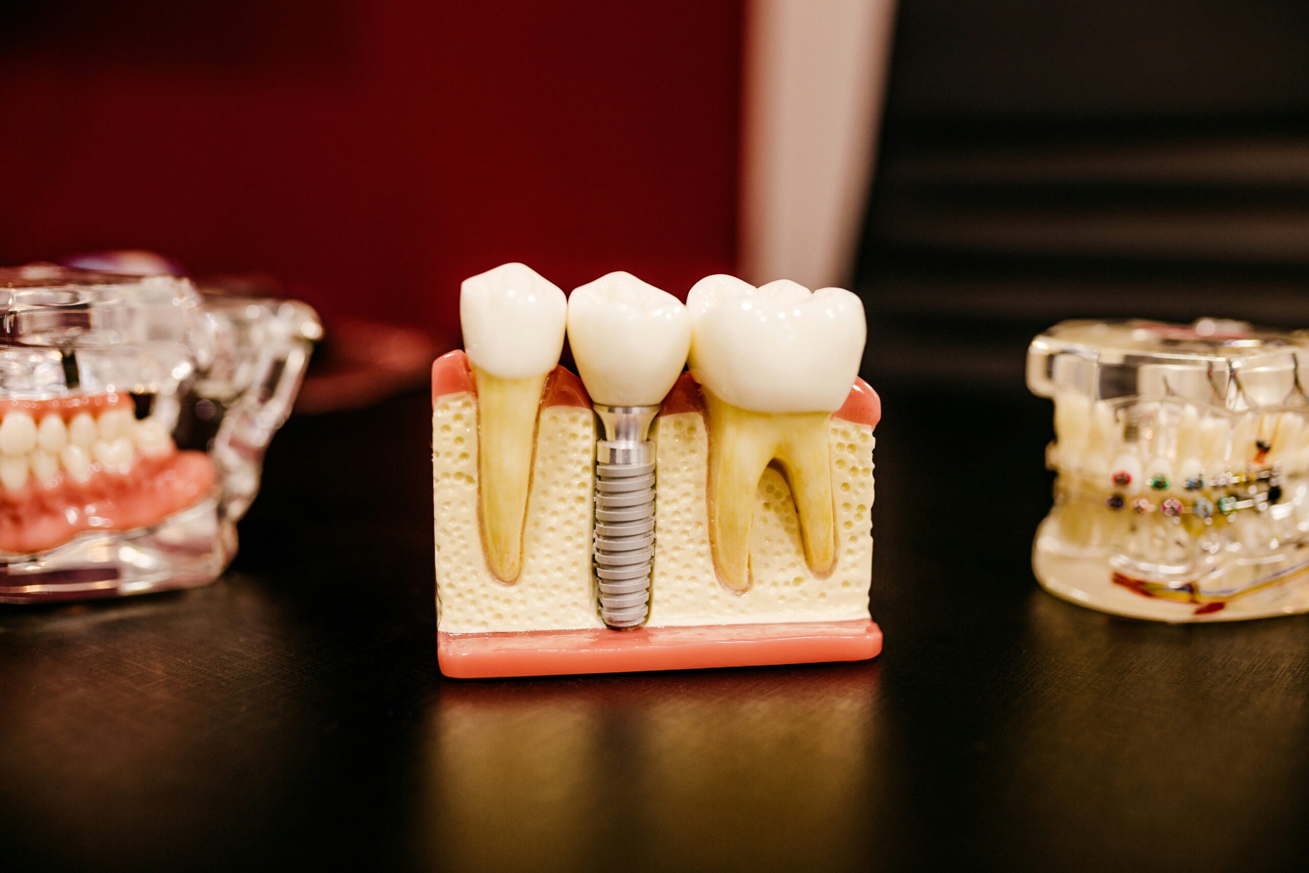 Dental implants